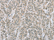 The image on the left is immunohistochemistry of paraffin-embedded Human esophagus cancer tissue using CSB-PA025575(EDA2R Antibody) at dilution 1/50, on the right is treated with fusion protein. (Original magnification: ×200)