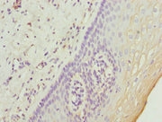 Immunohistochemistry of paraffin-embedded human cervical cancer using CSB-PA025587ESR1HU at dilution of 1:100