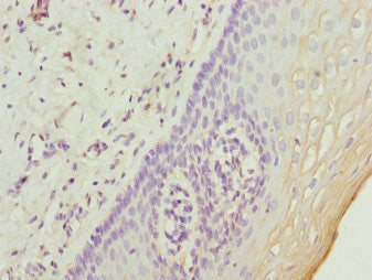 Immunohistochemistry of paraffin-embedded human cervical cancer using CSB-PA025587ESR1HU at dilution of 1:100