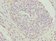 Immunohistochemistry of paraffin-embedded human cervical cancer using CSB-PA025587ESR2HU at dilution of 1:100