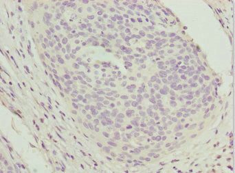 Immunohistochemistry of paraffin-embedded human cervical cancer using CSB-PA025587ESR2HU at dilution of 1:100