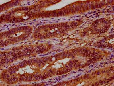 IHC image of CSB-PA025598LA01HU diluted at 1:300 and staining in paraffin-embedded human colon cancer performed on a Leica BondTM system. After dewaxing and hydration, antigen retrieval was mediated by high pressure in a citrate buffer (pH 6.0). S...