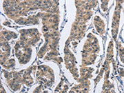 The image on the left is immunohistochemistry of paraffin-embedded Human breast cancer tissue using CSB-PA025645(DSG2 Antibody) at dilution 1/50, on the right is treated with fusion protein. (Original magnification: ×200)