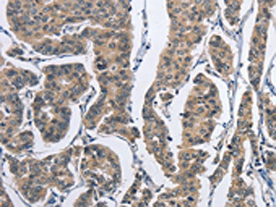 The image on the left is immunohistochemistry of paraffin-embedded Human breast cancer tissue using CSB-PA025645(DSG2 Antibody) at dilution 1/50, on the right is treated with fusion protein. (Original magnification: ×200)