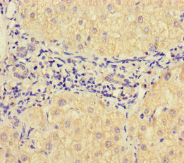 Immunohistochemistry of paraffin-embedded human liver cancer using CSB-PA025780LA01HU at dilution of 1:100