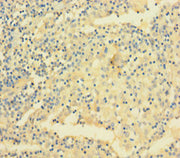 Immunohistochemistry of paraffin-embedded human lung cancer using CSB-PA025784LA01HU at dilution of 1:100