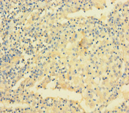 Immunohistochemistry of paraffin-embedded human lung cancer using CSB-PA025784LA01HU at dilution of 1:100