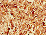 Immunohistochemistry of paraffin-embedded human melanoma using CSB-PA025847LA01HU at dilution of 1:100