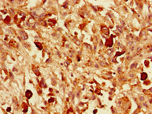 Immunohistochemistry of paraffin-embedded human melanoma using CSB-PA025847LA01HU at dilution of 1:100