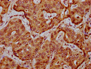 IHC image of CSB-PA025865LA01HU diluted at 1:300 and staining in paraffin-embedded human liver cancer performed on a Leica BondTM system. After dewaxing and hydration, antigen retrieval was mediated by high pressure in a citrate buffer (pH 6.0). S...
