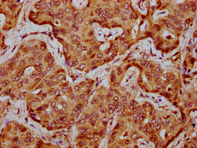IHC image of CSB-PA025865LA01HU diluted at 1:300 and staining in paraffin-embedded human liver cancer performed on a Leica BondTM system. After dewaxing and hydration, antigen retrieval was mediated by high pressure in a citrate buffer (pH 6.0). S...