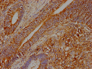 IHC image of CSB-PA025965LA01HU diluted at 1:400 and staining in paraffin-embedded human colon cancer performed on a Leica BondTM system. After dewaxing and hydration, antigen retrieval was mediated by high pressure in a citrate buffer (pH 6.0). S...