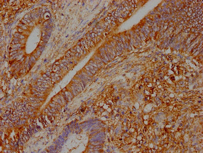 IHC image of CSB-PA025965LA01HU diluted at 1:400 and staining in paraffin-embedded human colon cancer performed on a Leica BondTM system. After dewaxing and hydration, antigen retrieval was mediated by high pressure in a citrate buffer (pH 6.0). S...