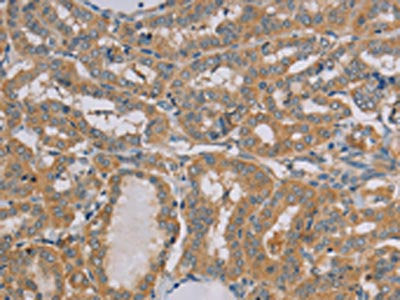 The image on the left is immunohistochemistry of paraffin-embedded Human thyroid cancer tissue using CSB-PA026004(MTUS1 Antibody) at dilution 1/20, on the right is treated with fusion protein. (Original magnification: ×200)