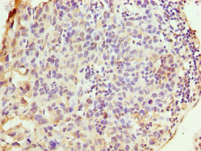 Immunohistochemistry of paraffin-embedded human bladder cancer using CSB-PA026050LA01HU at dilution of 1:100