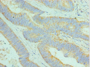 Immunohistochemistry of paraffin-embedded human colon cancer using CSB-PA026056ESR2HU at dilution of 1:100