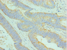 Immunohistochemistry of paraffin-embedded human colon cancer using CSB-PA026056ESR2HU at dilution of 1:100