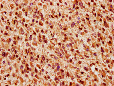 IHC image of CSB-PA026123LA01HU diluted at 1:200 and staining in paraffin-embedded human glioma performed on a Leica BondTM system. After dewaxing and hydration, antigen retrieval was mediated by high pressure in a citrate buffer (pH 6.0). Section...