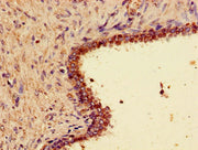Immunohistochemistry of paraffin-embedded human prostate cancer using CSB-PA026141LA01HU at dilution of 1:100
