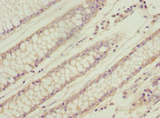 Immunohistochemistry of paraffin-embedded human colon cancer using CSB-PA026145ESR1HU at dilution of 1:100