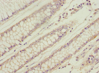 Immunohistochemistry of paraffin-embedded human colon cancer using CSB-PA026145ESR1HU at dilution of 1:100