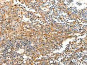 The image on the left is immunohistochemistry of paraffin-embedded Human tonsil tissue using CSB-PA026205(DTX3 Antibody) at dilution 1/20, on the right is treated with fusion protein. (Original magnification: ×200)