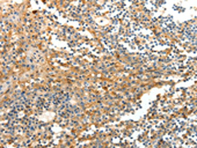 The image on the left is immunohistochemistry of paraffin-embedded Human tonsil tissue using CSB-PA026205(DTX3 Antibody) at dilution 1/20, on the right is treated with fusion protein. (Original magnification: ×200)