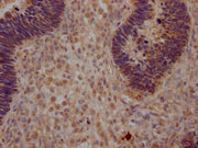 IHC image of CSB-PA026244LA01HU diluted at 1:200 and staining in paraffin-embedded human ovarian cancer performed on a Leica BondTM system. After dewaxing and hydration, antigen retrieval was mediated by high pressure in a citrate buffer (pH 6.0)....