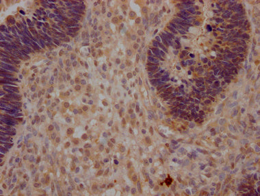 IHC image of CSB-PA026244LA01HU diluted at 1:200 and staining in paraffin-embedded human ovarian cancer performed on a Leica BondTM system. After dewaxing and hydration, antigen retrieval was mediated by high pressure in a citrate buffer (pH 6.0)....
