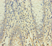 Immunohistochemistry of paraffin-embedded human colon cancer using CSB-PA026270LA01HU at dilution of 1:100