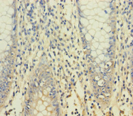 Immunohistochemistry of paraffin-embedded human colon cancer using CSB-PA026270LA01HU at dilution of 1:100