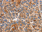 The image on the left is immunohistochemistry of paraffin-embedded Human liver cancer tissue using CSB-PA026284(SMURF1 Antibody) at dilution 1/15, on the right is treated with synthetic peptide. (Original magnification: ×200)
