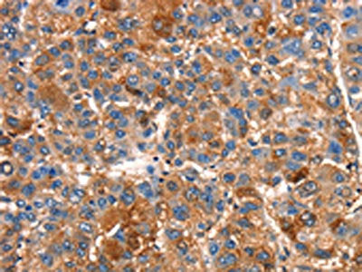 The image on the left is immunohistochemistry of paraffin-embedded Human liver cancer tissue using CSB-PA026284(SMURF1 Antibody) at dilution 1/15, on the right is treated with synthetic peptide. (Original magnification: ×200)