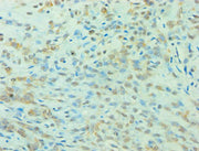 Immunohistochemistry of paraffin-embedded human breast cancer using CSB-PA026290ESR2HU at dilution of 1:100