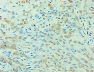 Immunohistochemistry of paraffin-embedded human breast cancer using CSB-PA026290ESR2HU at dilution of 1:100