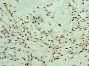 Immunohistochemistry of paraffin-embedded human breast cancer using CSB-PA026425DSR2HU at dilution of 1:100