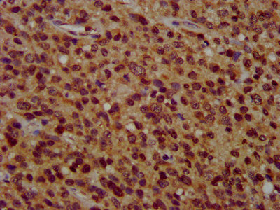 IHC image of CSB-PA026467LA01HU diluted at 1:400 and staining in paraffin-embedded human glioma performed on a Leica BondTM system. After dewaxing and hydration, antigen retrieval was mediated by high pressure in a citrate buffer (pH 6.0). Section...