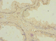 Immunohistochemistry of paraffin-embedded human prostate cancer using CSB-PA026486ESR1HU at dilution of 1:100
