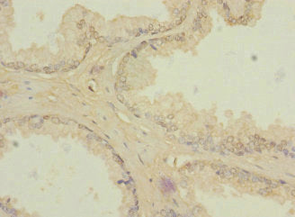 Immunohistochemistry of paraffin-embedded human prostate cancer using CSB-PA026486ESR1HU at dilution of 1:100