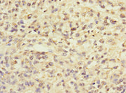 Immunohistochemistry of paraffin-embedded human melanoma using CSB-PA026486ESR2HU at dilution of 1:100
