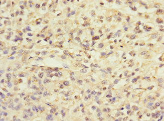 Immunohistochemistry of paraffin-embedded human melanoma using CSB-PA026486ESR2HU at dilution of 1:100