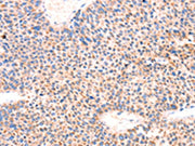 The image on the left is immunohistochemistry of paraffin-embedded Human liver cancer tissue using CSB-PA026505(AMPD1 Antibody) at dilution 1/70, on the right is treated with synthetic peptide. (Original magnification: ×200)