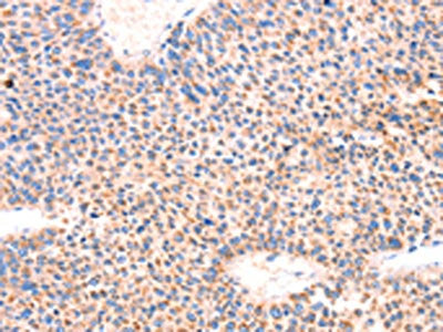 The image on the left is immunohistochemistry of paraffin-embedded Human liver cancer tissue using CSB-PA026505(AMPD1 Antibody) at dilution 1/70, on the right is treated with synthetic peptide. (Original magnification: ×200)