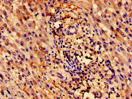 Immunohistochemistry of paraffin-embedded human liver cancer using CSB-PA026546LA01HU at dilution of 1:100