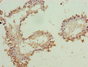 Immunohistochemistry of paraffin-embedded human breast cancer using CSB-PA026563LA01HU at dilution of 1:100