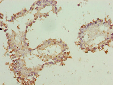 Immunohistochemistry of paraffin-embedded human breast cancer using CSB-PA026563LA01HU at dilution of 1:100