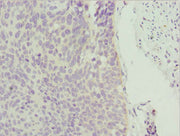 Immunohistochemistry of paraffin-embedded human cervical cancer using CSB-PA026565ESR1HU at dilution of 1:100