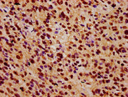 IHC image of CSB-PA026592LA01HU diluted at 1:500 and staining in paraffin-embedded human glioma performed on a Leica BondTM system. After dewaxing and hydration, antigen retrieval was mediated by high pressure in a citrate buffer (pH 6.0). Section...