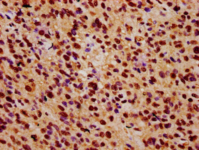 IHC image of CSB-PA026592LA01HU diluted at 1:500 and staining in paraffin-embedded human glioma performed on a Leica BondTM system. After dewaxing and hydration, antigen retrieval was mediated by high pressure in a citrate buffer (pH 6.0). Section...