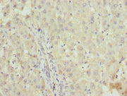 Immunohistochemistry of paraffin-embedded human liver cancer using CSB-PA026613ESR1HU at dilution of 1:100
